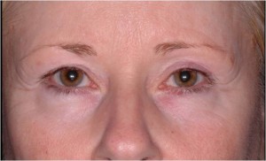Ulthera- Ultherapy after