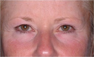 Ulthera- Ultherapy before