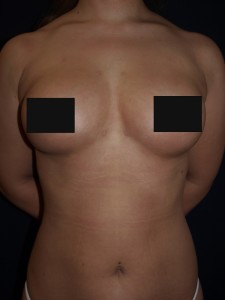 breast lipoaugmentation 1mospost-1