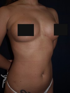 breast lipoaugmentation 1mospost-2