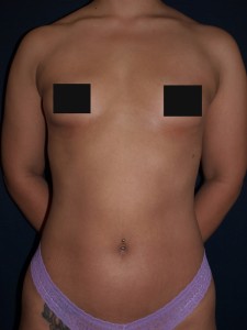 breast lipoaugmentation before-1-1