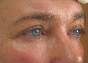 brow before