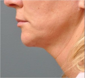 neck 1 after