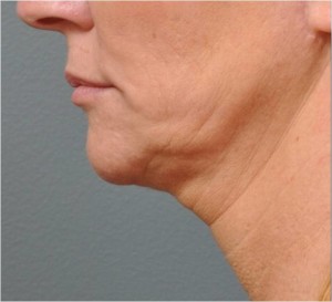 neck 1 before