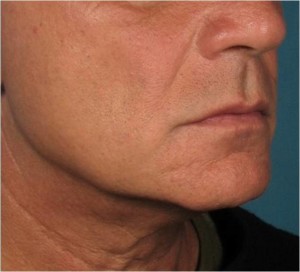 neck 2 after