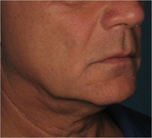 neck 2 before
