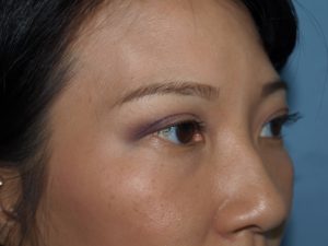eyelid surgery hawaii