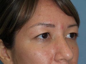 eyelid surgery hawaii